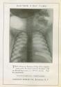 Kodak advertisement for Eastman X-Ray Film