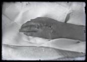 Hand after finger amputation surgery