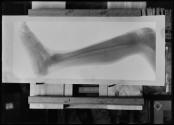 Radiograms of Foot & Leg (Human)