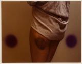 Bonnie's Bruise