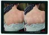 Urticaria (Dermographia)