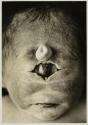 [Baby born with one eye in forehead]