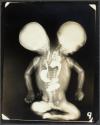 [X-ray of dicephalic twins]