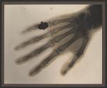 X-ray of the hand of Alvin Langdon Coburn