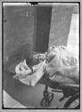 Tubercular Child, Bone Tuberculosis