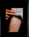 [Medical study of skin irritation]
