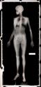 [Full body X-Ray of woman, head in profile, diamond wedding band on left hand, metal rod through each heel of shoe]